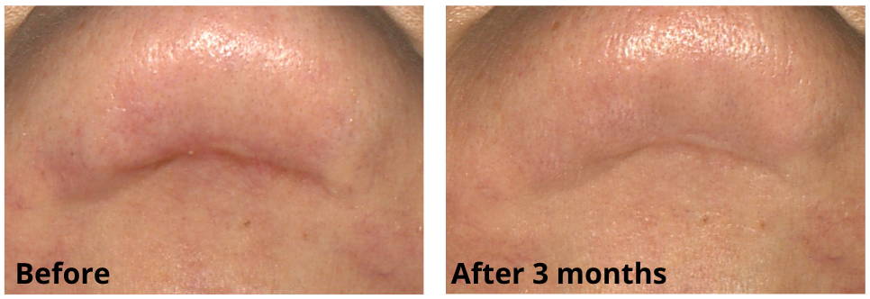 Sẹo Cằm Trước Và Sau Khi Sử Dụng Skinuva Scar Trong 3 Tháng